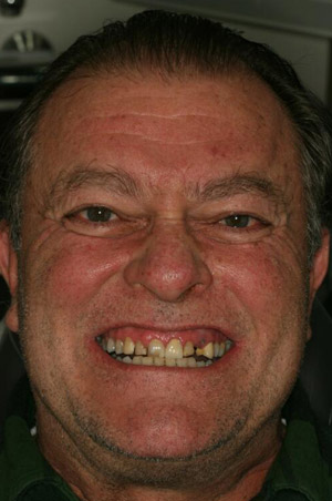 Man with flawed smile before dental crown restoration