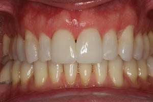 Closeup of man's smile with aligned smile after dental crown restoration