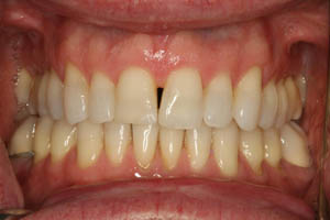 Closeup of man's smile with gap between front teeth