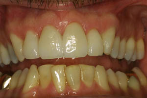 Healthy beautiful smile after dental crown restoration