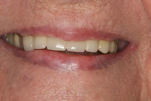 Perfect smile after dental crown restoration