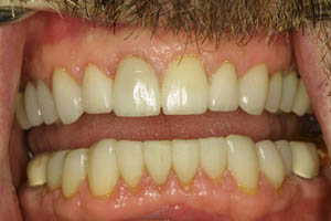 Closeup of smile with new dental restorations