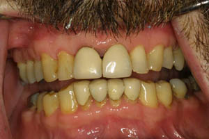 Closeup of smile with old dental restorations