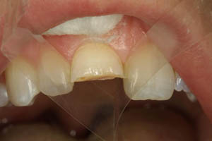 Closeup of smile with broken top tooth