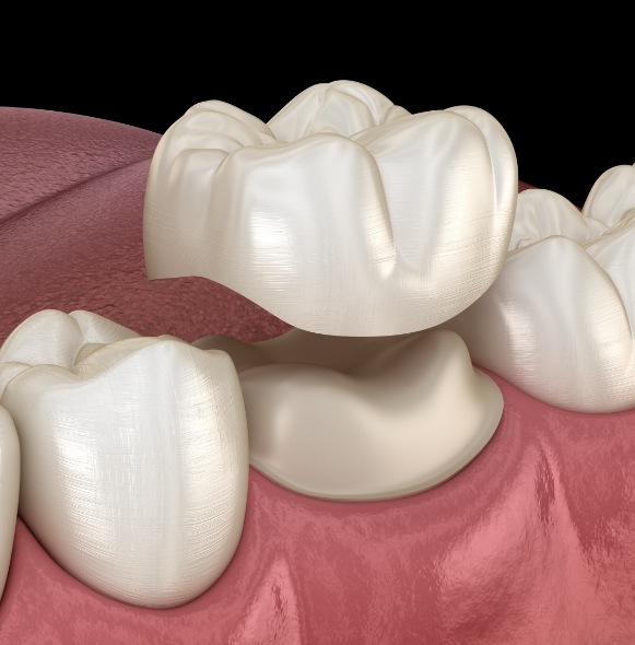 Animated smile during dental crown placement