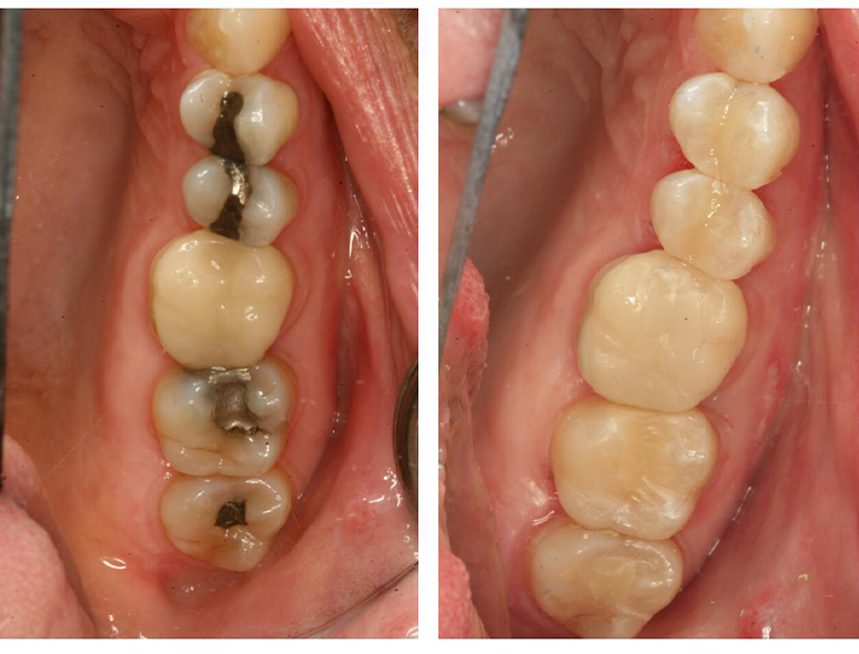 Smile with metal fillings compared to smile with tooth colored fillings
