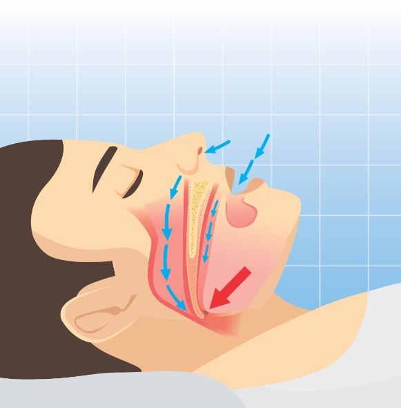 Animated person sleeping demonstrating obstructed airway