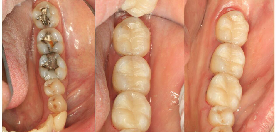 Smile comparing original metal fillings to new tooth colored fillings