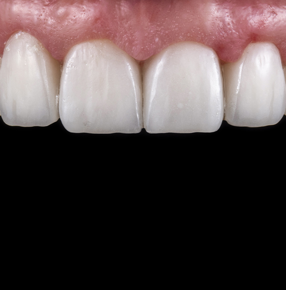 Closeup of flawless smile after tooth colored filling restoration
