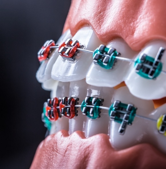 Closeup of smile with traditional braces that have brightly colored brackets