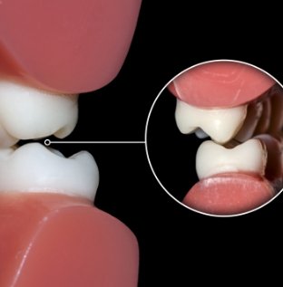 Animated smile demonstrating bite misalignment