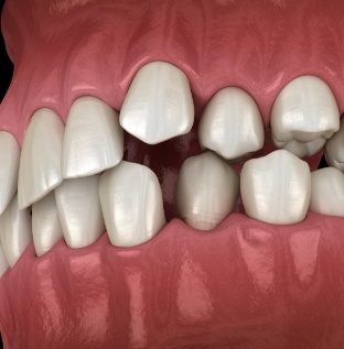 Animated smile with crowded and crooked teeth