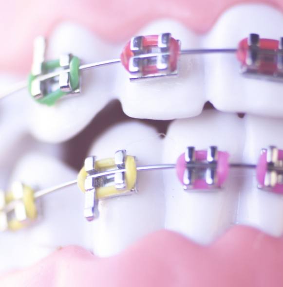 Closeup of smile with traditional bracket and wire braces