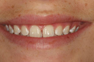 Closeup of smile with gaps between top teeth before porcelain veneers