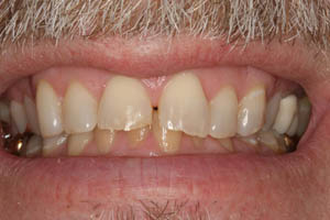 Closeup of smile with gap between front teeth before porcelain veneers