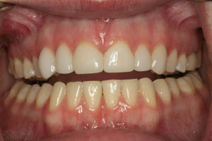 Closeup of dental patient's smile before porcelain veneer treatment