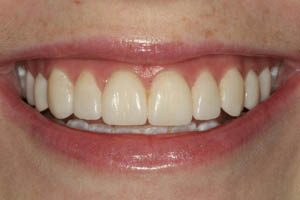 Closeup of woman's smile after porcelain veneers