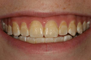 Closeup of woman's smile before porcelain veneers