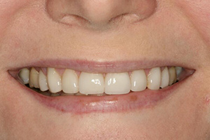 Closeup of older woman's smile perfected by porcelain veneers