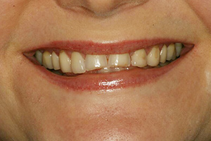 Closeup of older woman's worn down top front teeth
