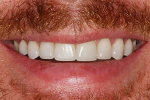 Closeup of bright smile after porcelain veneers