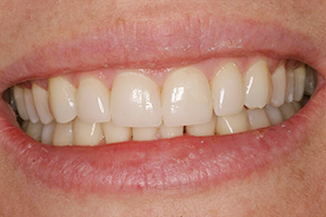 Closeup of woman's smile with top teeth lengthened by porcelain veneers