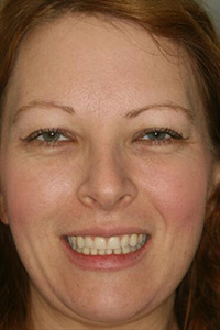 Woman with short top teeth before porcelain veneers