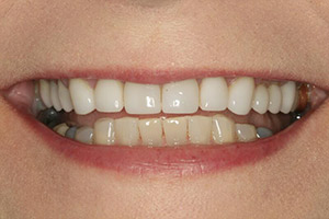 Beautiful smile after porcelain veneers