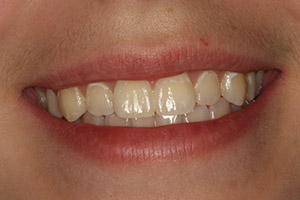 Closeup of young woman's smile before porcelain veneers