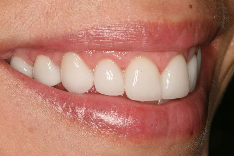 Closeup of side of smile damaged tooth corrected by porcelain veneers