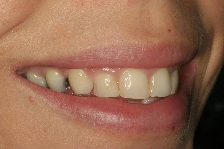 Closeup of side of smile with damaged tooth