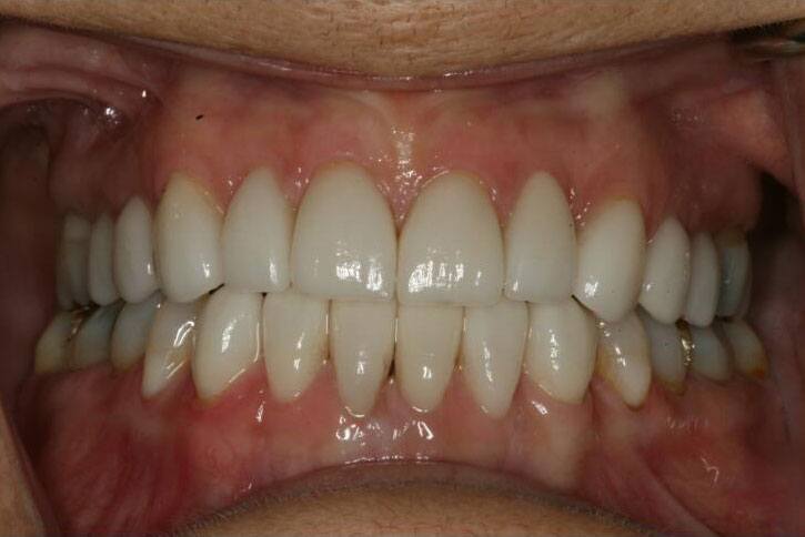 Smile with gaps on top and bottom teeth closed by porcelain veneers