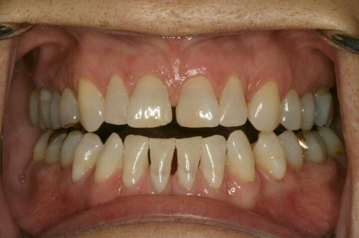 Smile with numerous gaps between top and bottom teeth