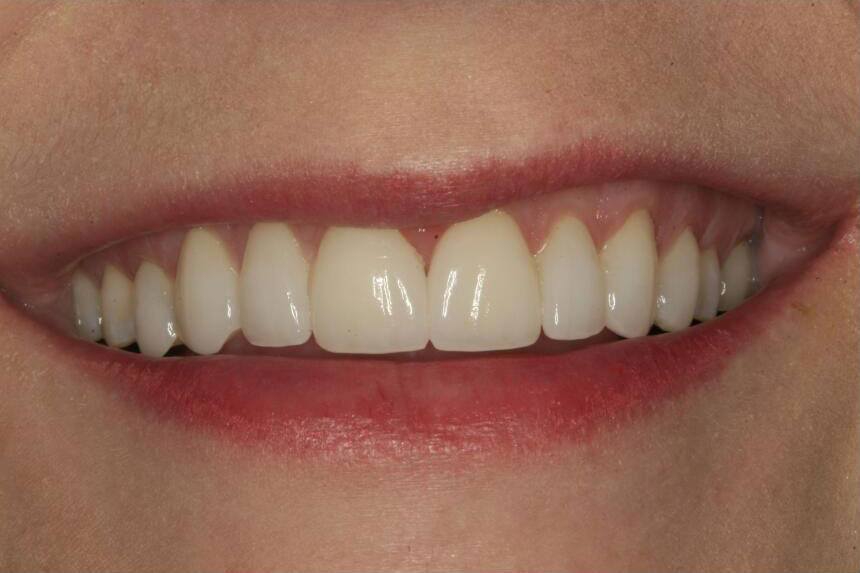Smile with porcelain veneers creating an even gum line