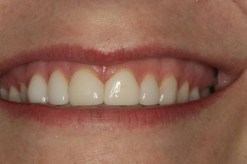 Smile with uneven gum line