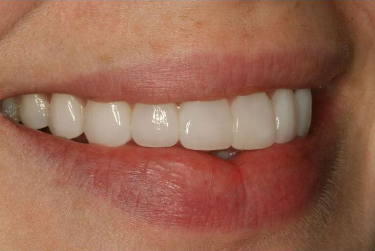 Smile with porcelain veneers correcting the length of the top side tooth