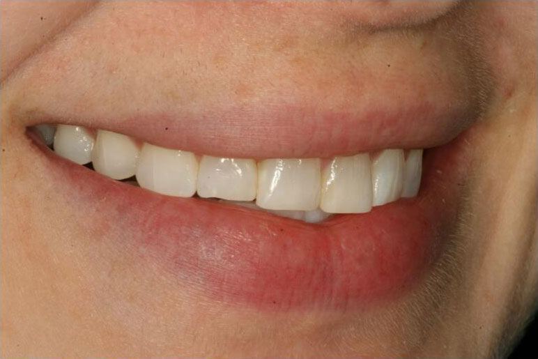Smile with shorter top side tooth