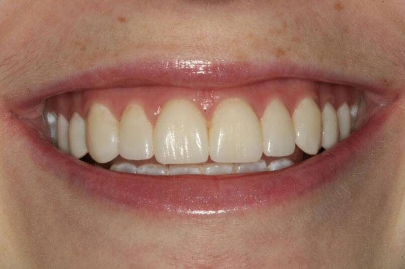 Closeup of healthy bright white smile after porcelain veneers
