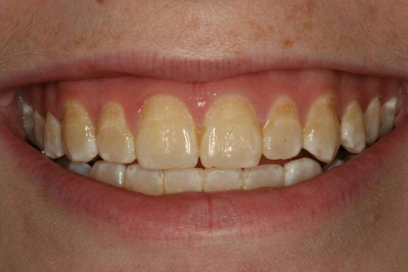 Closeup of severely discolored smile