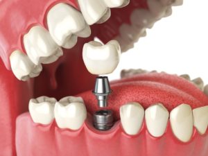 Dental implant in lower arch