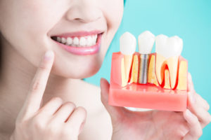 Smiling woman showing replica of dental implant