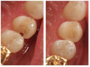 before and after tooth colored filling 
