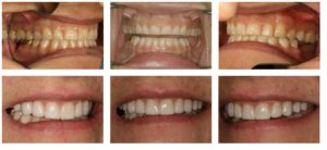 case study dental crowns