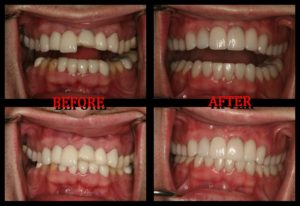 patient's full-mouth reconstruction