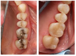 metal and white fillings comparison