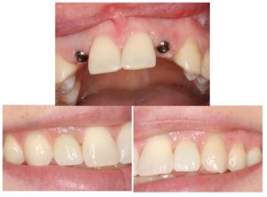 dental implant case
