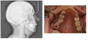 palatal constriction