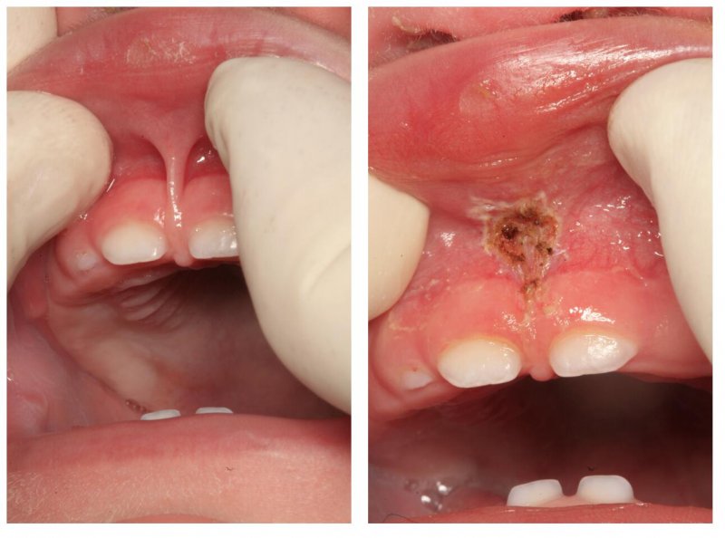 Mouth before and after frenectomy