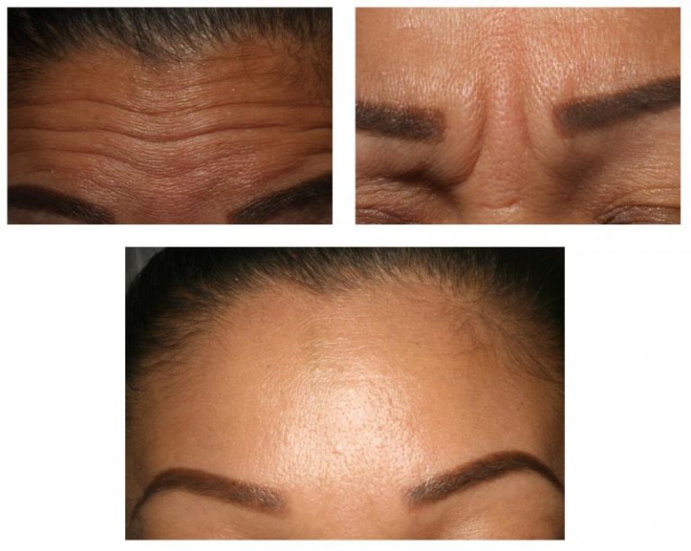 Dentist in Kittanning Botox Dentist Voller Dentistry