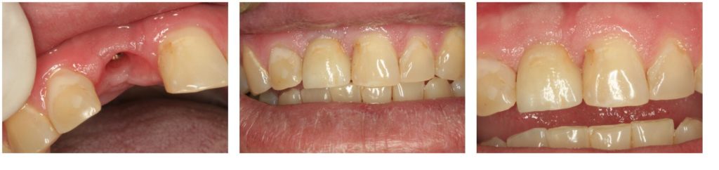 Series of teeth from missing tooth to dental implant placement